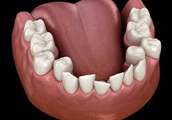 Illustration of crooked teeth