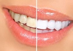 Cosmetic dentistry is an investment in your smile and in your self-esteem