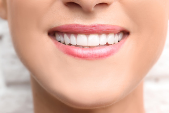 closeup of person smiling after getting veneers